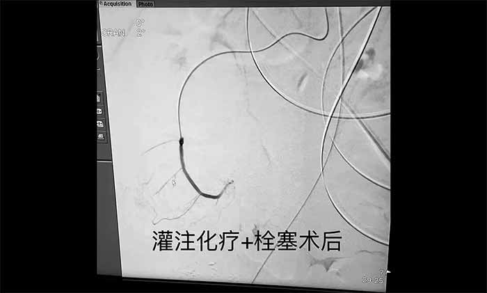 <b>�������� ҽ������ | ��Ժ��������ע��������Ѫ��˨�����뼼�����ٶ�������������·��</b>